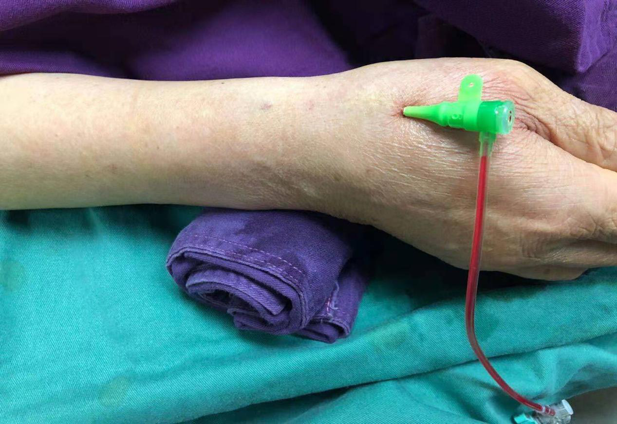 舍近求远远端桡动脉穿刺让患者更舒适